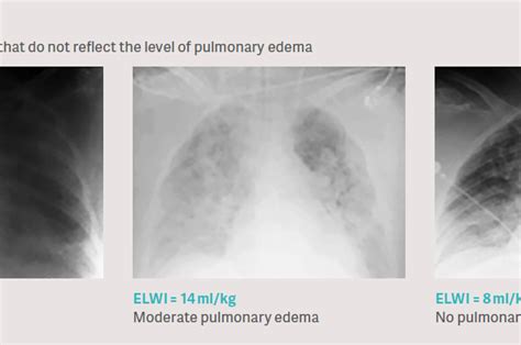 Pulmonary Edema Vs Pneumonia Chest X Ray My Xxx Hot Girl