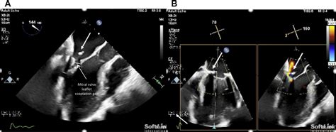 A Novel 3d Echocardiographic Rendering Tool For Assessment Of Mitral