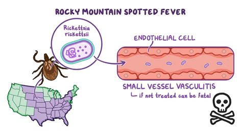 Rocky Mountain Spotted Fever Rmsf Nursing Osmosis Video Library