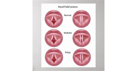 Vocal Cord Lesions Poster Zazzle