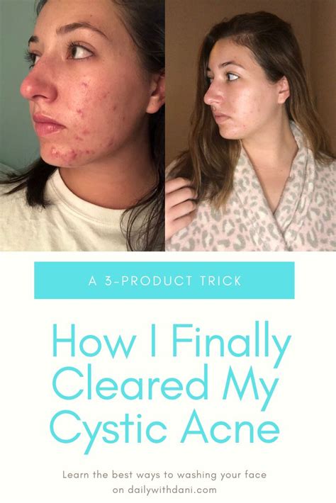 How I Finally Cleared My Cystic Acne Clear Skin Fast Bad Acne