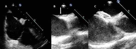 Tee Before And After Pfo Closure In Patient 1 A Pfo In The