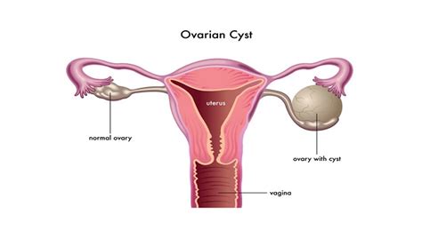 Treatment options for fibrocystic breast disease are limited. 8 Easy Ways To Shrink Your Ovarian Cysts Naturally - Just ...