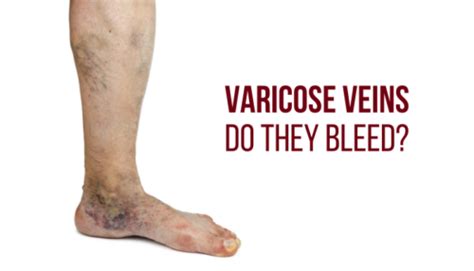 Burst Varicose Veins Bruise Dr Abhilash