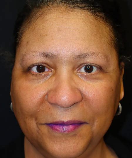 Before And After Gallery Oculofacial Reconstruction Doctor Rosh