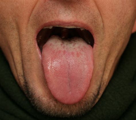 Healthy Tongue Cracks Gtsite