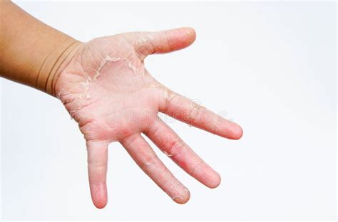 The Dry Hands Peel Contact Dermatitis Fungal Infections Skin Inf