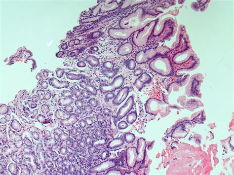 Case Of Gastric Intestinal Metaplasia In An Old Patient With Previous