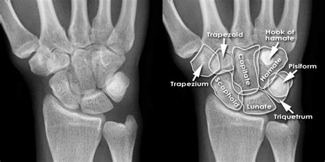 Trauma X Ray Upper Limb Wrist