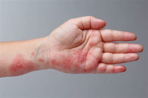 Shingles Rash Stock Photos Pictures And Royalty Free Images Istock