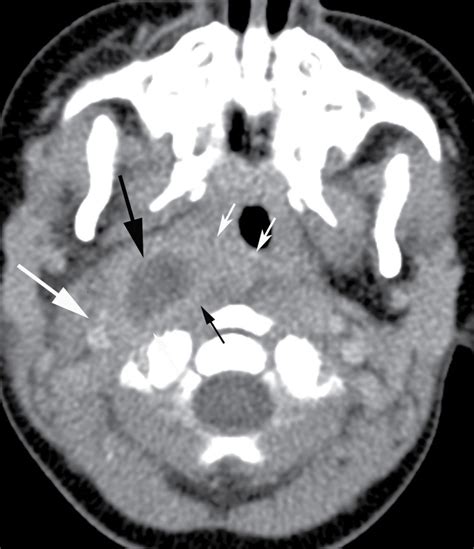 The Acute Neck Inflammation Infections And Trauma Radiology Key