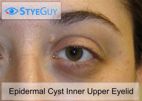 Epidermal Inclusion Cyst Eyelid