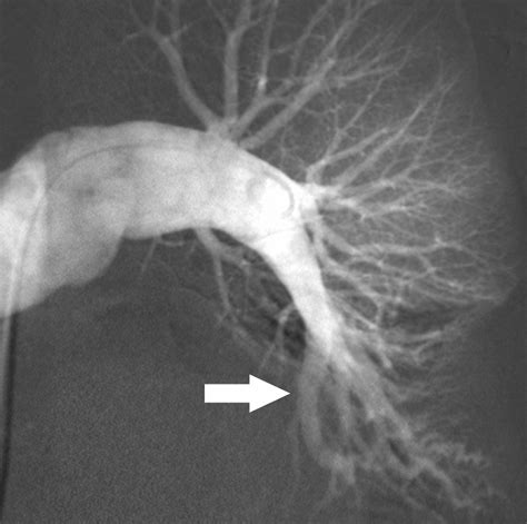 Ct Angiography Of Pulmonary Embolism Diagnostic Criteria And Causes Of
