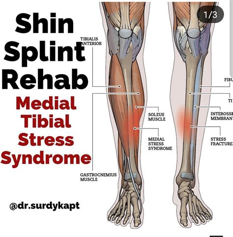 Muscles Medial Tibial Stress Syndrome