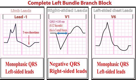 Ekg Bundle Branch Block Identification