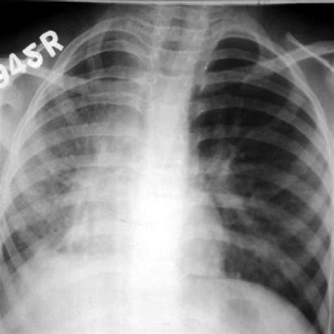 Chest Radiograph Shows A Small Right Hemithorax With Increased Opacity