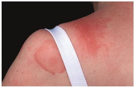 Urticaria Classification And Causes