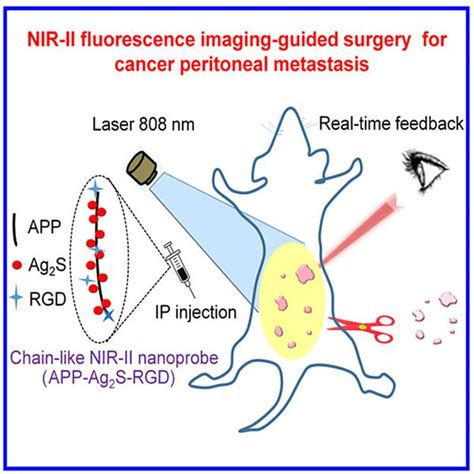 Nir Ii Fluorescence Guided Precise Cytoreductive Surgery Suzhou