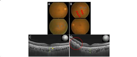 Initial Findings On Color Fundus Photography Cfp And Swept Source