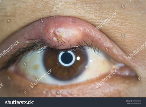 Close Upper Eyelid Abscess Stye Hordeolum Foto De Stock 470007014