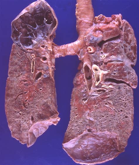 Filesarcoidosis Bullous Emphysema Fibrosis
