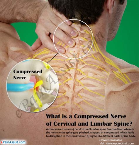What Happens If You Have Compressed Nerve Of The Cervical And Lumbar Spine