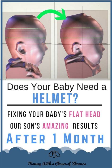 Fixing Our Sons Flat Head With A Cranial Helmet Flat Head Baby Mom