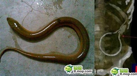 Chinese Man Requires Emergency Surgery After The Swamp Eel He Stuck Up