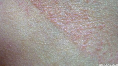 Polymorphous Light Eruptionpmle Pictures And Sun Allergy Rash Images