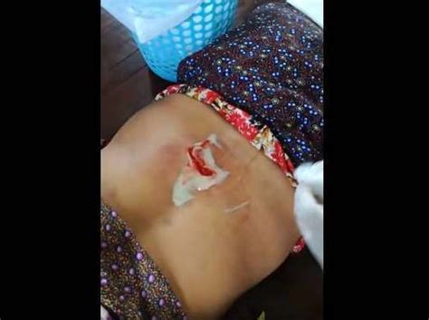 Huge Boil Popping On Back Archives New Pimple Popping Videos