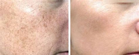 Ipl Skin Rejuvenation By M22 London Premier Laser Clinic