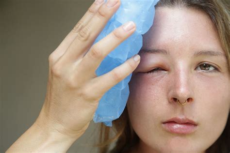 Swollen Eyelids Causes And Treatment