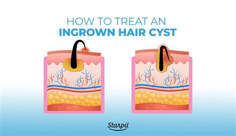 Ingrown Hair Cysts Treatments Causes And Symptoms 2023