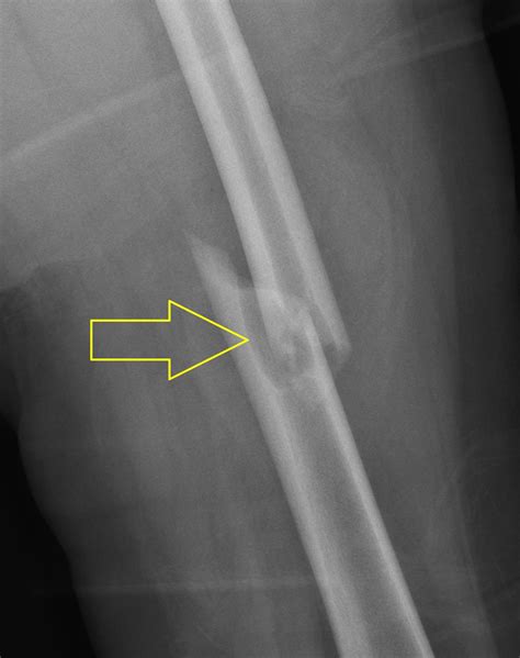 Unicameral Bone Cyst With Fracture Femur Image