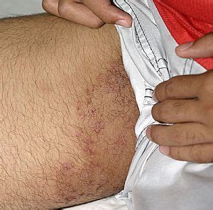 These drugs include allylamines and azoles, such as clotrimazole or terbinafine hydrochloride, which may be available in the form of a powder, spray, or lotion. Home treatment for Tinea Cruris or Jock Itch - Ayurveda