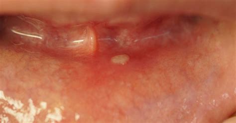 Cracking The Canker Code Diving Into The White Depths Of Oral Sores