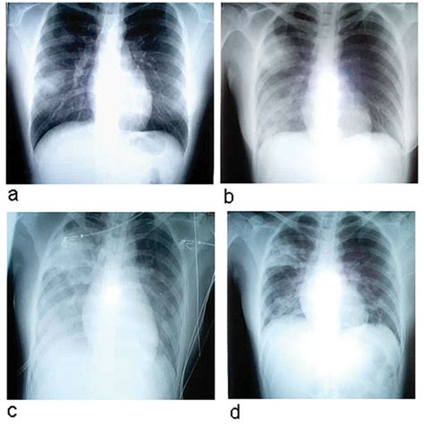 Sars can also be spread indirectly via surfaces that have been touched by someone who is infected with the virus. Figure 1 - Severe Acute Respiratory Syndrome (SARS) in Singapore: Clinical Features of Index ...