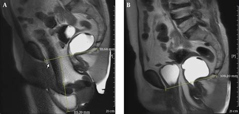 A 54 y/o female with bladder outlet obstruction and ...