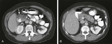 Anomalies And Anatomic Variants Of The Pancreas Radiology Key