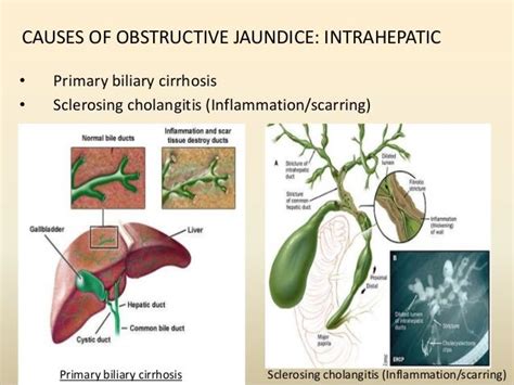 Causes Of Obstructive Jaundice Extrahepatic• Choledocholithiasis