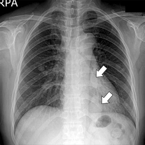 Initial Chest X Ray The Chest Radiography Reveals Two Multilobulated