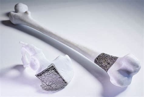 Just In Time Implants New Australian Project Will Use 3d Printing And