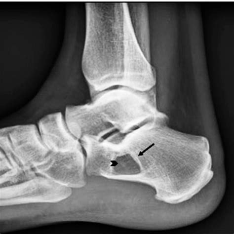 Plain Radiography Lateral Projection Lytic Calcaneus Lesion Arrow