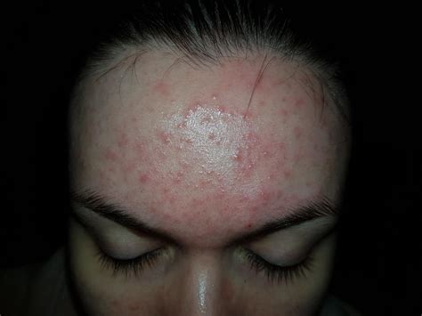 Red Irritating Bumps Mainly On Forehead Please Help Me With Photo