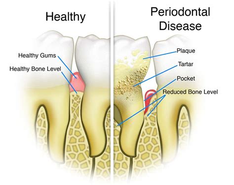 Periodontal Disease Gum Disease Bright Smiles Dental Care