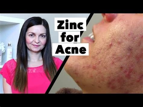 Zinc acne treatment is a measure to improve the condition of the skin from the inside with positive effects, accompanied by the effect of regulating if a dermatologist diagnoses you are zinc deficient, there are many ways you can add these essential nutrients, such as taking supplements, eating. Zinc for Acne Treatment - How Much Zinc Supplement to Take ...