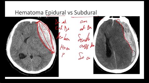 Diferencia en 2 Minutos de Hematoma Epidural vs Subdural Tomografía