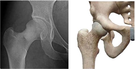 Guidance For The Treatment Of Femoral Neck Fracture With Precise
