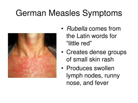 Ppt German Measles Rubella Powerpoint Presentation Free Download