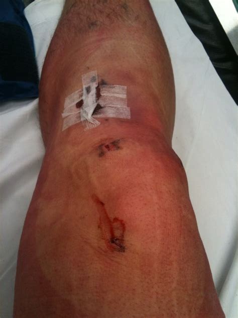 Reasons to have acl surgery. ACL Surgery Recovery - Day 2 - ACL Surgery Pain